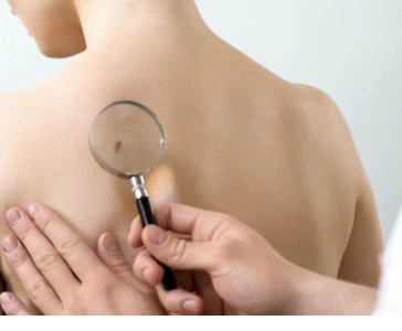 RETIRADA DE TUMORES MALIGNOS DA PELE: TRATAMENTO CIRÚRGICO COM SEGURANÇA E PRECISÃO